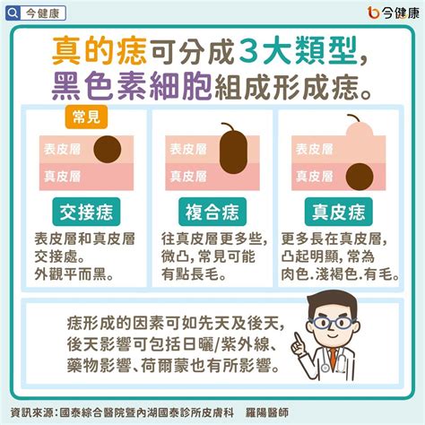 凸痣長毛|是痣or皮膚癌？醫「1張圖秒對照」 長這2部位最危險